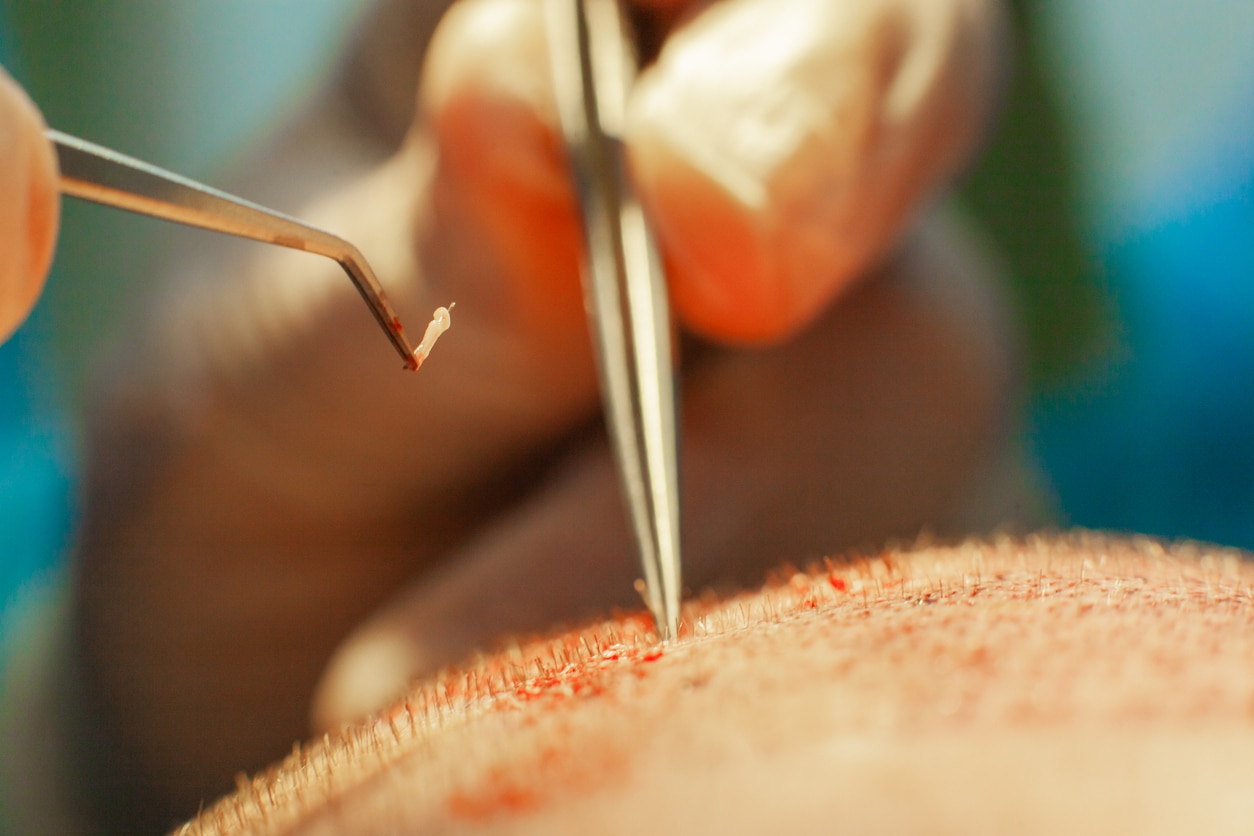 capillaires implants
