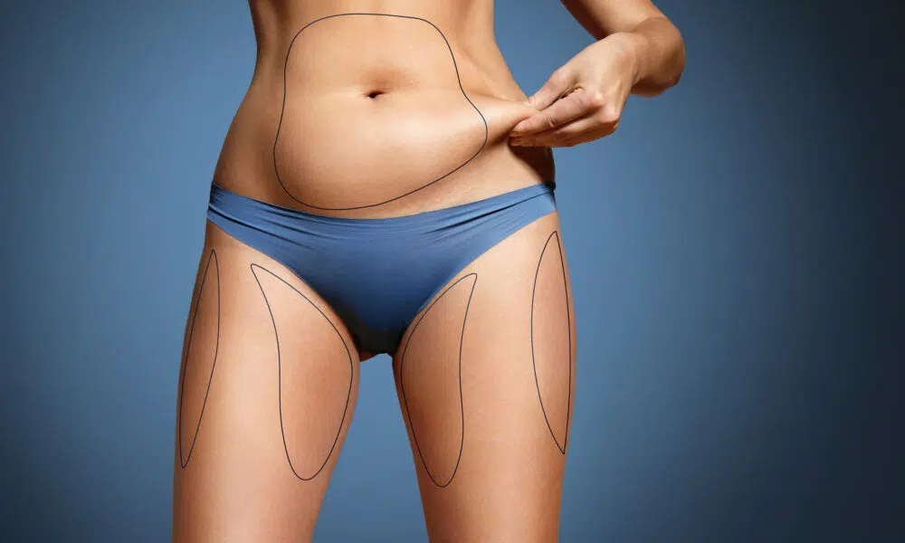 chirurgie esthétique la liposuccion