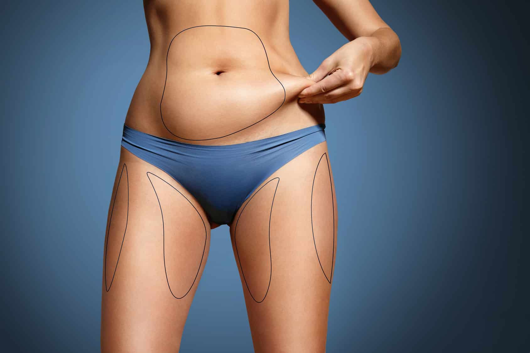 chirurgie esthétique la liposuccion