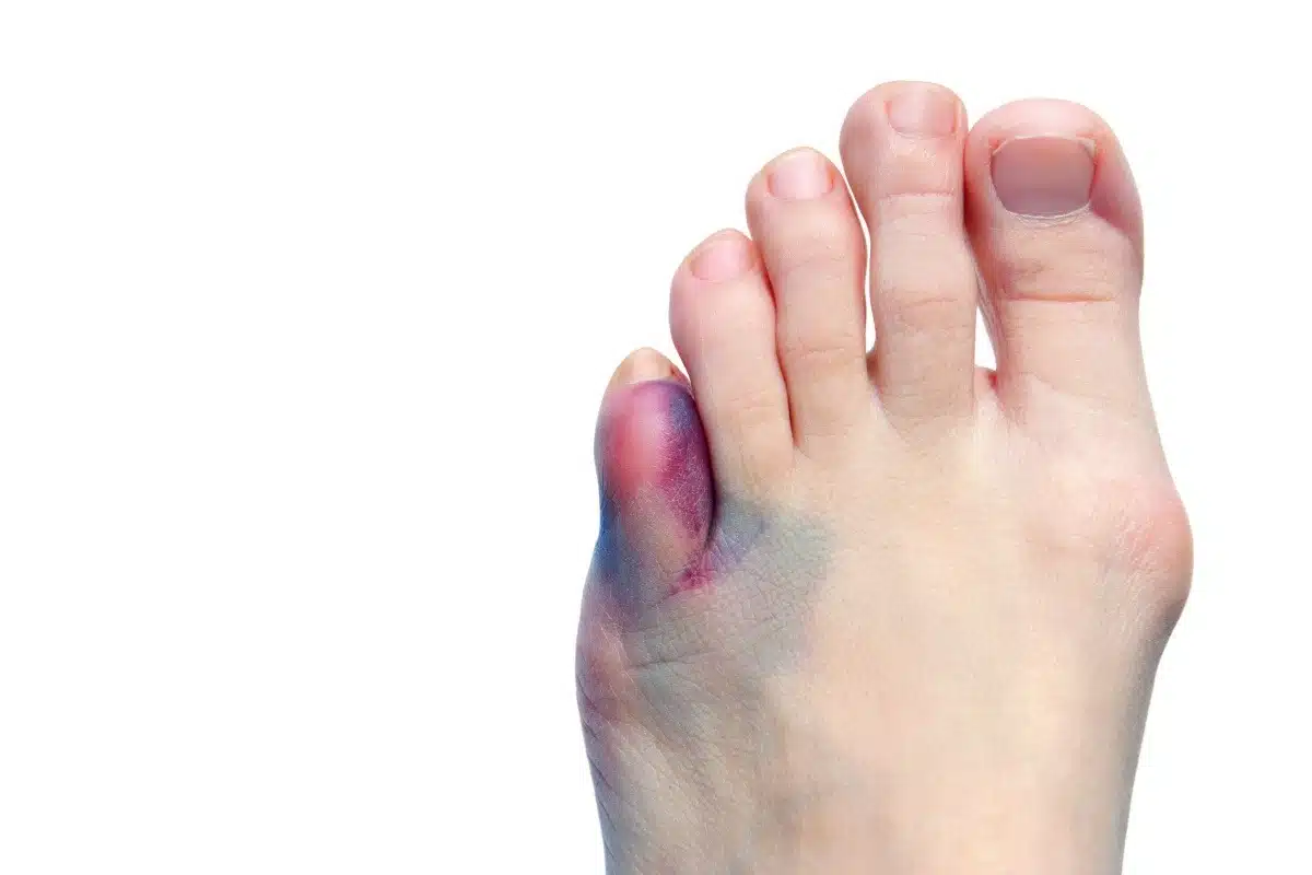 Peut-on marcher avec une fracture du pied ? Mythes et réalités